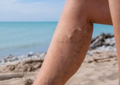 Venous Insufficiency