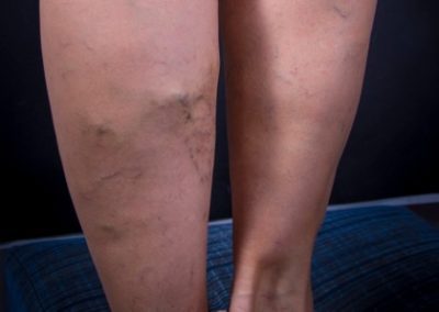 Venous Insufficiency