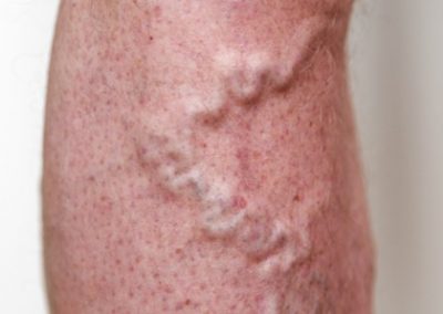 Venous Insufficiency