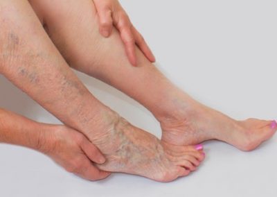 Venous Insufficiency