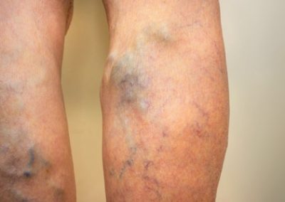 Venous Insufficiency