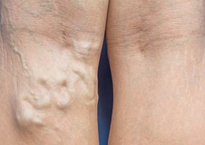 Venous Insufficiency