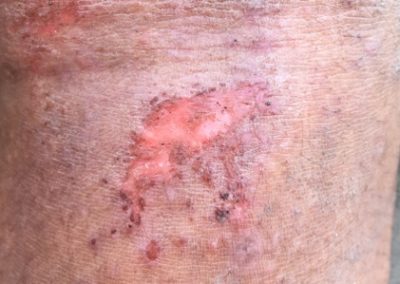 Venous Insufficiency