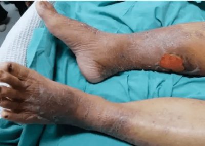 Venous Insufficiency