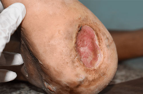 Arterial Ulcer