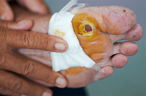 Arterial Ulcer