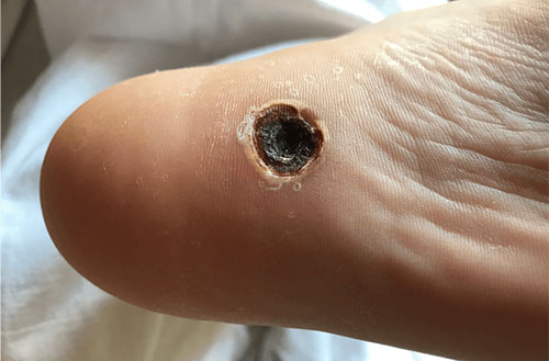 Arterial Ulcer