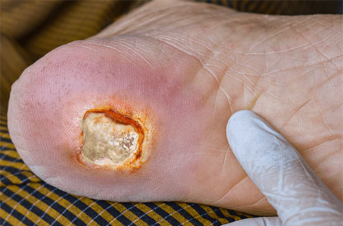 Arterial Ulcer