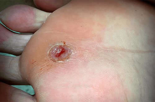 Arterial Ulcer