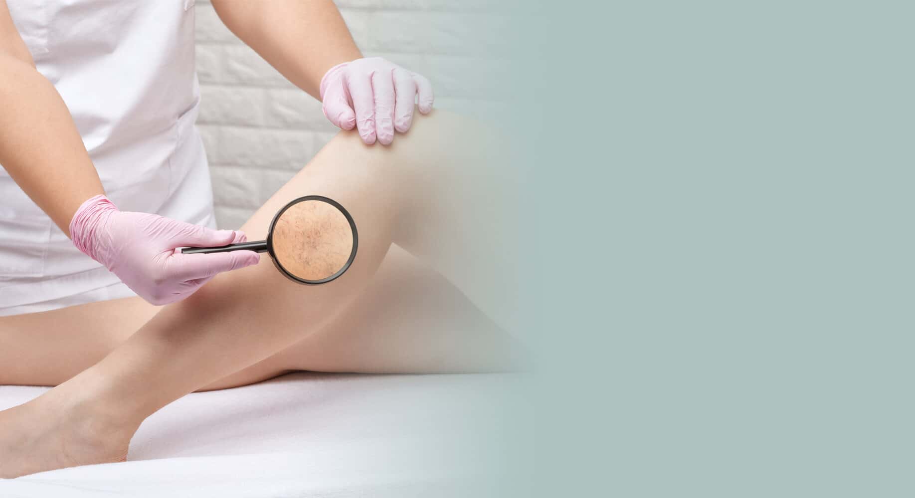 Varicose Vein Treatment