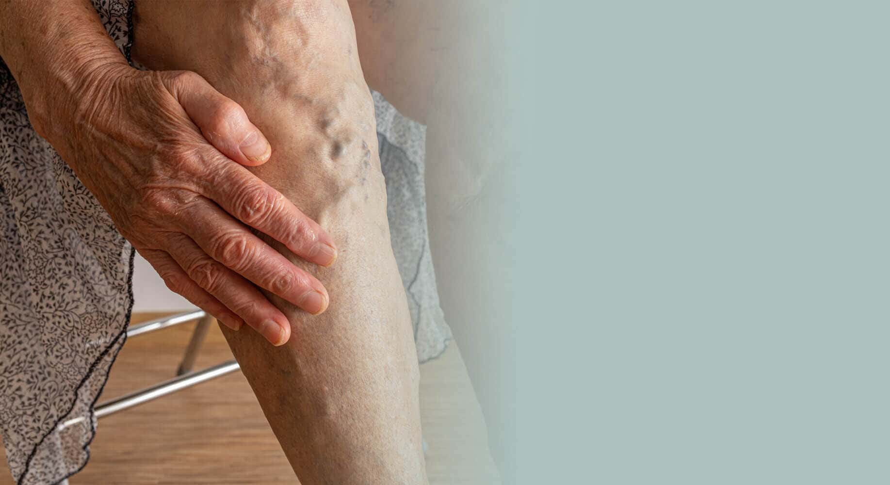 Vascular Ulcers