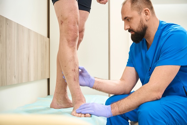 What Spider Vein Treatment Can Do For You