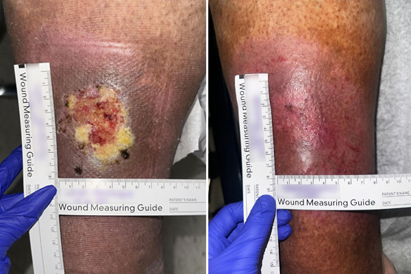 venous ulcer