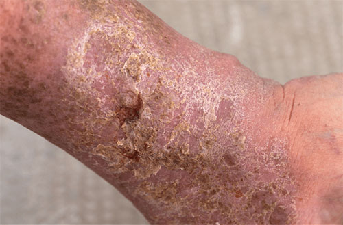 Venous Ulcer