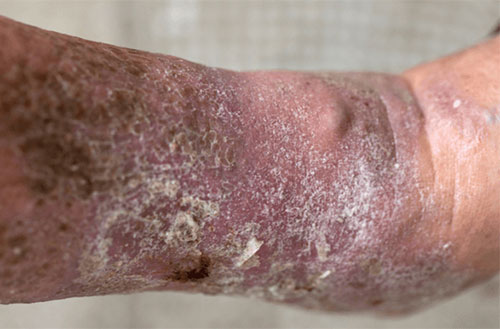 Venous Ulcer