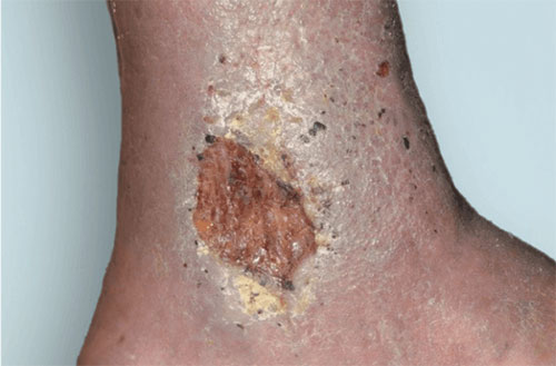 Venous Ulcer