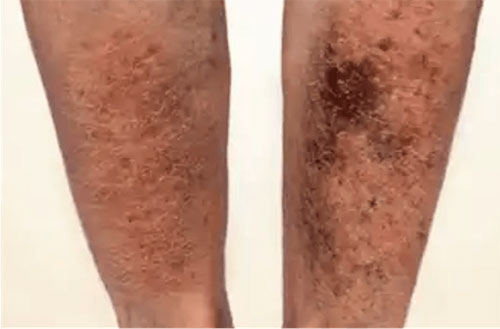 Venous Ulcer