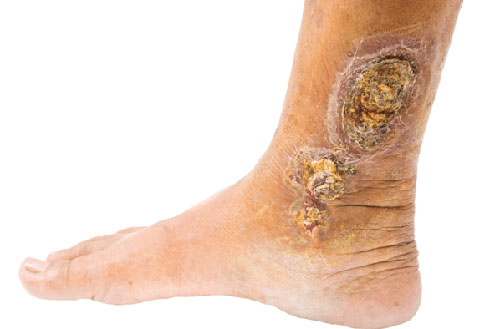 Venous Ulcer